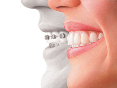 The image depicts a split-screen comparison of a person s face with and without dental braces, highlighting the transformation achieved through orthodontic treatment.