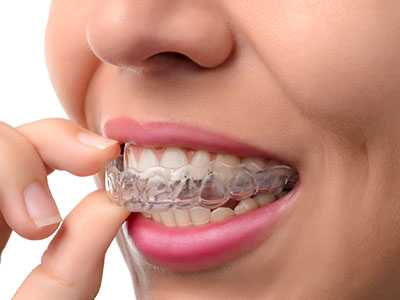 The image features a person with a clear aligner, which is a dental appliance used for orthodontic treatment, placed over their teeth, adjusting it by holding it between their fingers.