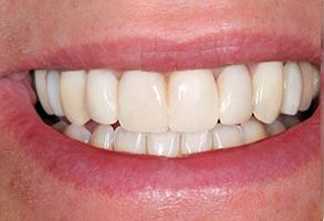 The image shows a person with a broad smile displaying straight white teeth.