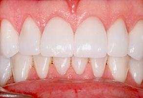 The image displays a close-up view of a person s teeth with visible stains and discoloration, which could suggest a need for dental care or cleaning.