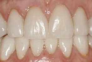 The image displays a close-up view of a person s mouth showing their teeth with white fillings and a partial smile.