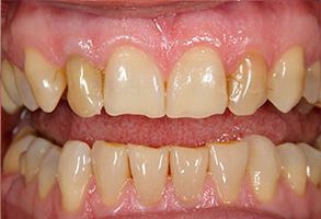 The image shows a close-up view of a person s teeth with yellowing, indicating possible dental issues such as tooth decay or staining.