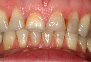 The image shows a close-up view of a person s teeth with visible yellowing and staining, indicating poor oral hygiene or potential dental issues.